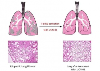 Ảnh 5 của Pulmonary fibrosis