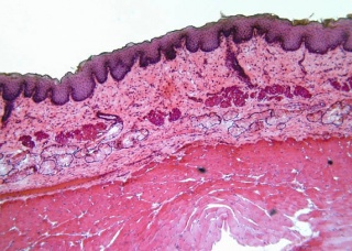 Ảnh 1 của Basal cell carcinoma