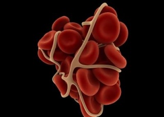 Ảnh 2 của Ban xuất huyết giảm tiểu cầu tự phát (ITP)