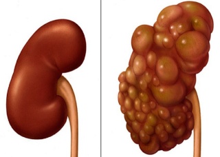 Ảnh 5 của Polycystic Kidney Disease