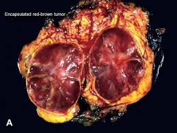 Ảnh 3 của Pancreatic cyst