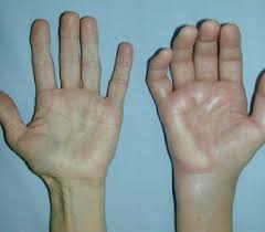Ảnh 1 của Complex regional pain syndrome