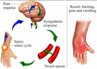 Ảnh 4 của Complex regional pain syndrome