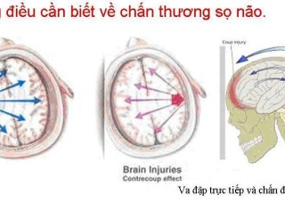 Ảnh 3 của Chấn thương sọ não