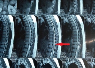 Ảnh 2 của Spinal Cord Tumor