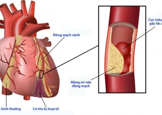 Ảnh 3 của Suy mạch máu do bệnh động mạch ngoại biên