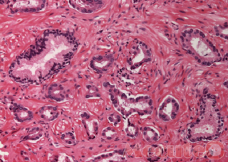 Ảnh 3 của Squamous Cell Carcinoma