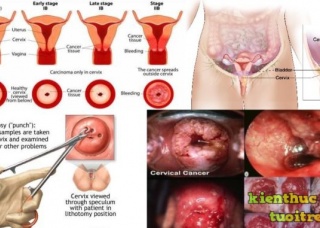 Ảnh 2 của Cervical cancer