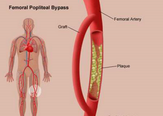 Ảnh 4 của Suy mạch máu do bệnh động mạch ngoại biên