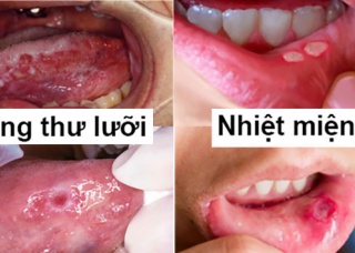 Ảnh 1 của Tongue cancer