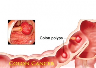Ảnh 2 của Colon cancer