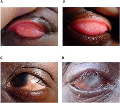 Ảnh 4 của Trachoma