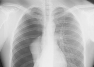 Ảnh 4 của Tràn khí màng phổi áp lực