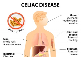 Ảnh 5 của Celiac (Tiêu chảy phân mỡ)