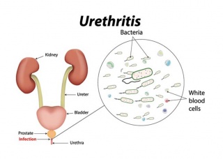 Ảnh 4 của Urethritis