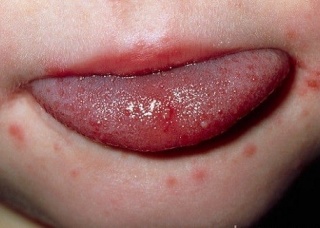 Ảnh 2 của Viêm miệng do virus Herpes