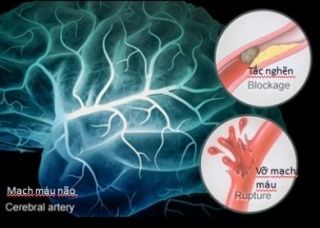 Ảnh 3 của Cerebrovascular accident (CVA)