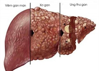 Ảnh 1 của Chronic Liver Disease