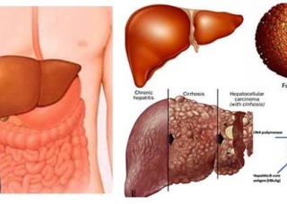 Ảnh 3 của Chronic Liver Disease