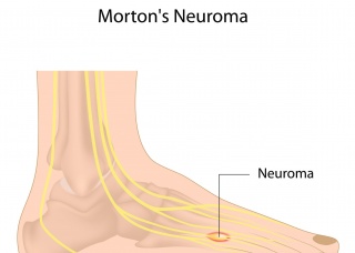 Ảnh 2 của U thần kinh Morton