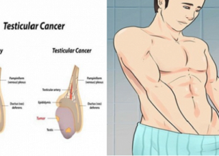 Ảnh 4 của Cancer of the testicles