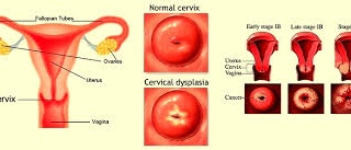 Ảnh 3 của Cervical Dysplasia