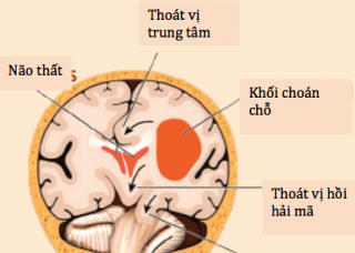 Ảnh 2 của Cerebral venous thrombosis
