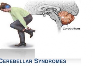 Ảnh 1 của Cerebellar syndrome