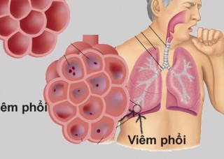 Ảnh 1 của Viêm phổi do vi-rút