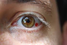 Ảnh 2 của Viêm tế bào ổ mắt