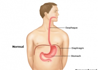 Ảnh 1 của Diaphragmatic hernia