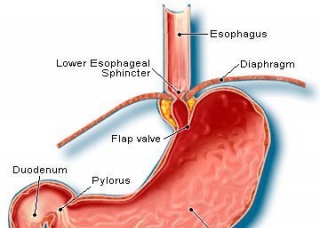 Ảnh 2 của Diaphragmatic hernia