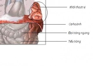 Ảnh 3 của Diaphragmatic hernia