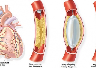 Ảnh 3 của Dị tật động mạch vành