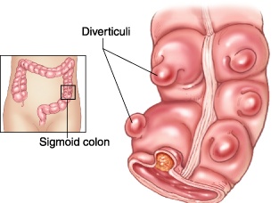 Ảnh 2 của Diverticulitis