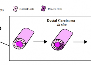 Ảnh 1 của Ductal Carcinoma In Situ