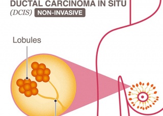 Ảnh 2 của Ductal Carcinoma In Situ
