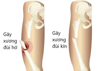 Ảnh 3 của Foot fracture