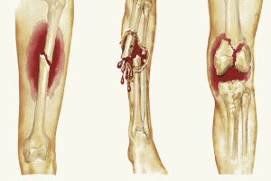 Ảnh 4 của Foot fracture