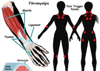 Ảnh 3 của Fibromyalgia Syndrome