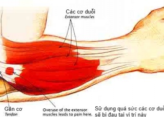 Ảnh 4 của Hội chứng đau khuỷu tay chơi Gôn