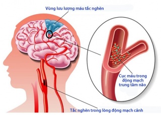 Ảnh 1 của Cơn thiếu máu não thoáng qua (TIA)