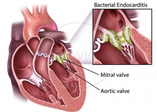Ảnh 4 của Infective endocarditis