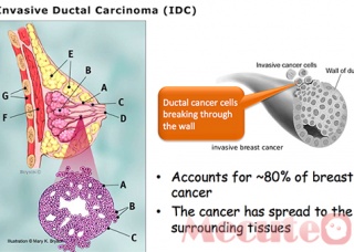 Ảnh 4 của Ung thư biểu mô tiểu thùy tại chỗ