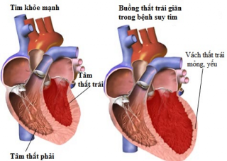 Ảnh 1 của Hội chứng suy tim trái