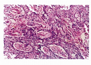 Ảnh 2 của Ung thư biểu mô tế bào đáy (BCC)