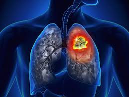 Ảnh 4 của Ung thư phổi tế bào nhỏ (SCLC)