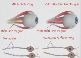 Ảnh 1 của Viêm dây thần kinh thị giác