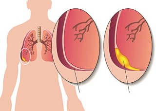 Ảnh 3 của Viêm màng phổi 