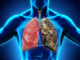 Ảnh 1 của Viêm phổi do hóa chất